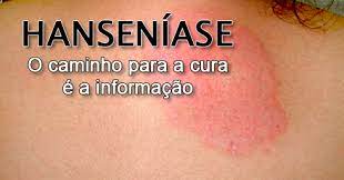 Hansen&iacute;ase tem cura e tratamento completo pelo SUS lembra dermatologista