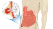 Hérnia inguinal atinge 20% dos homens em alguma fase da vida